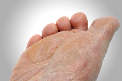  Itchy Rash on the Arch or Heel of the Foot